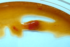 細菌性腸炎の便所見の写真